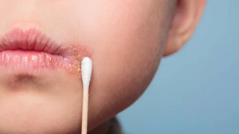 Get Rid of Cold Sore